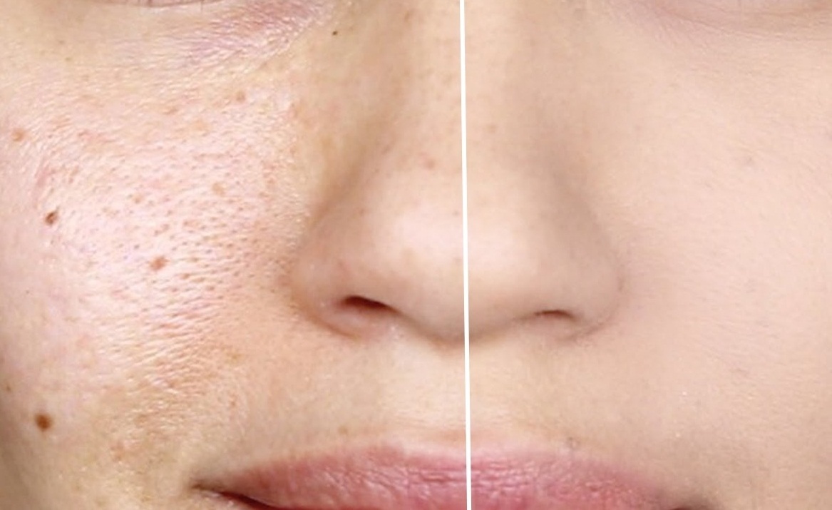 Pori Besar, Minyak Berlebih, dan Kulit Cepat Kusam? AGB dengan Niacinamide 8% & Bakuchiol Bisa Jadi Jawabannya