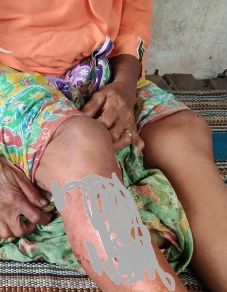 Diserang Buaya di Bagian Kaki, Mak-mak di Tanjabtim Derita 76 Jahitan