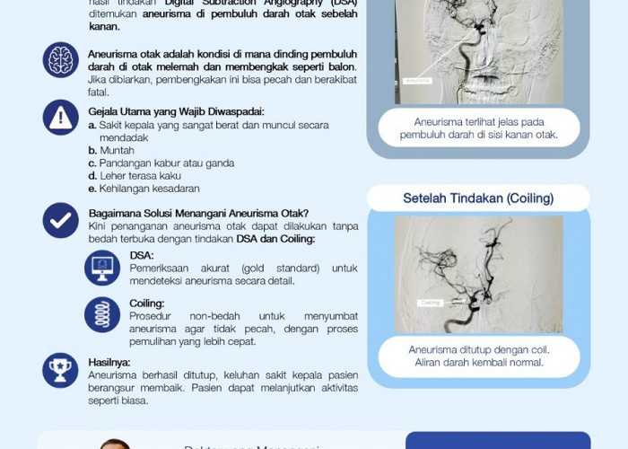 Aneurisma Cidera Otak Serius, Siloam Hospitals Jambi Lakukan Tindakan Tanpa Bedah